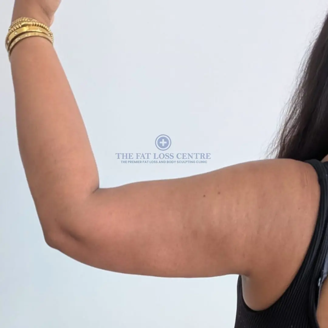 Upper Arms after VASER Lipo