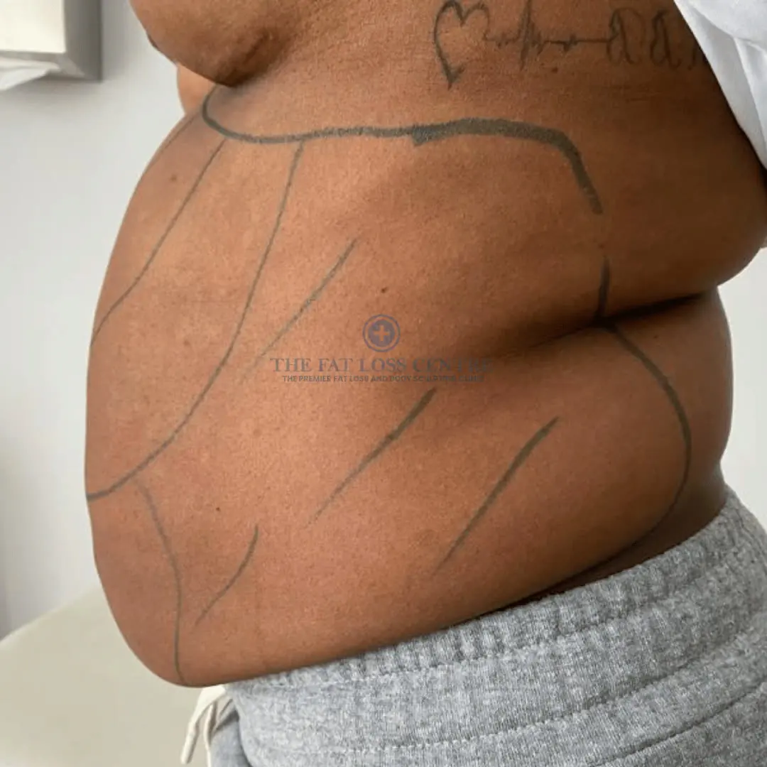 Abdomen before VASER Lipo