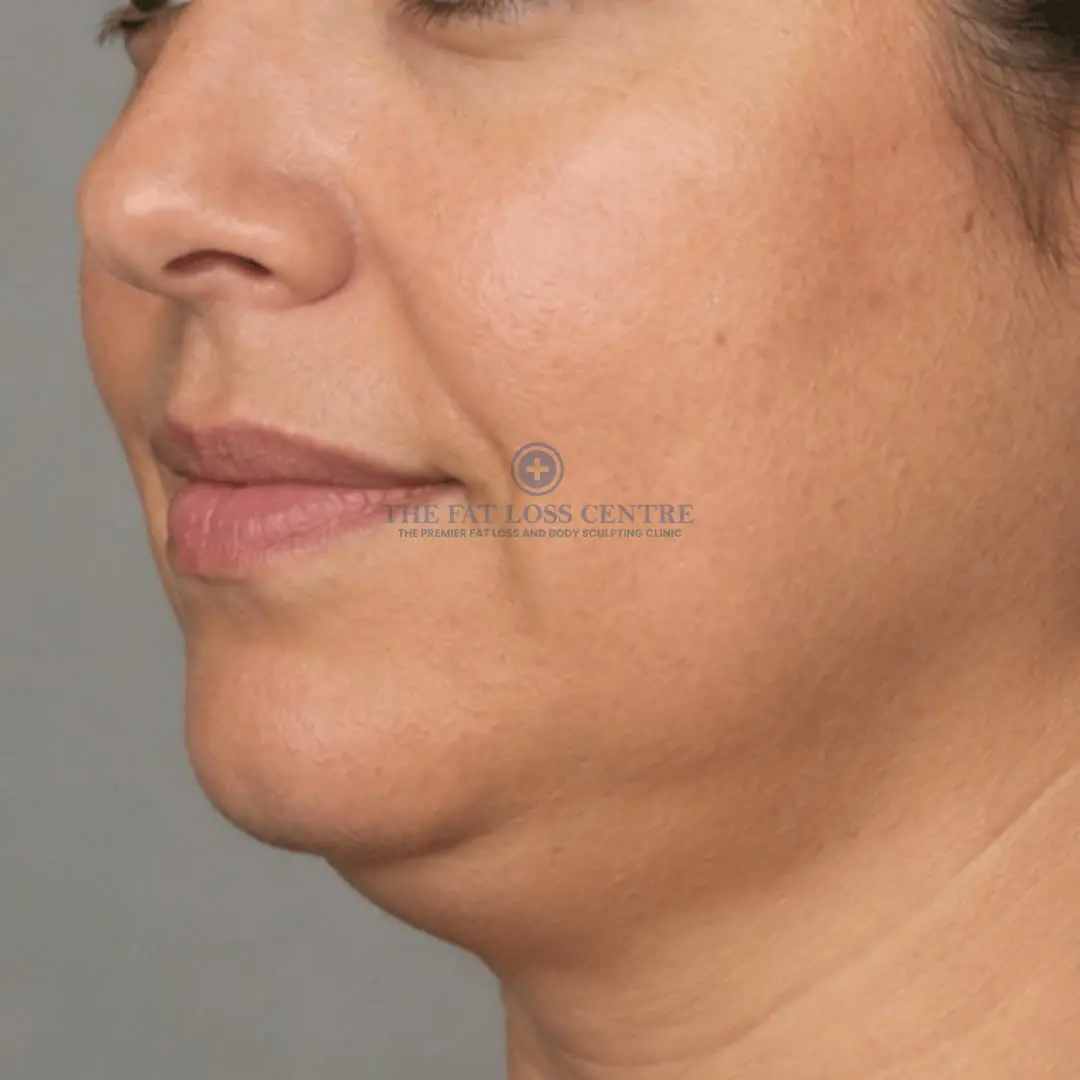 Jawline before NeoLift