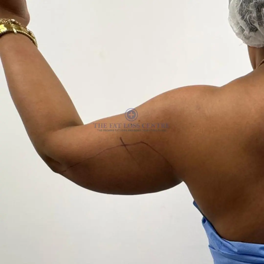 Upper Arms before VASER Lipo